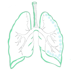Pneumothorax