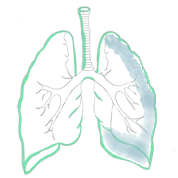 Pleural Effusion