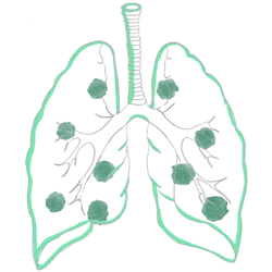 Pneumonia