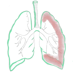 Hemothorax
